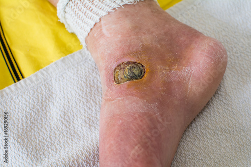 Canvastavla Diabetic Foot