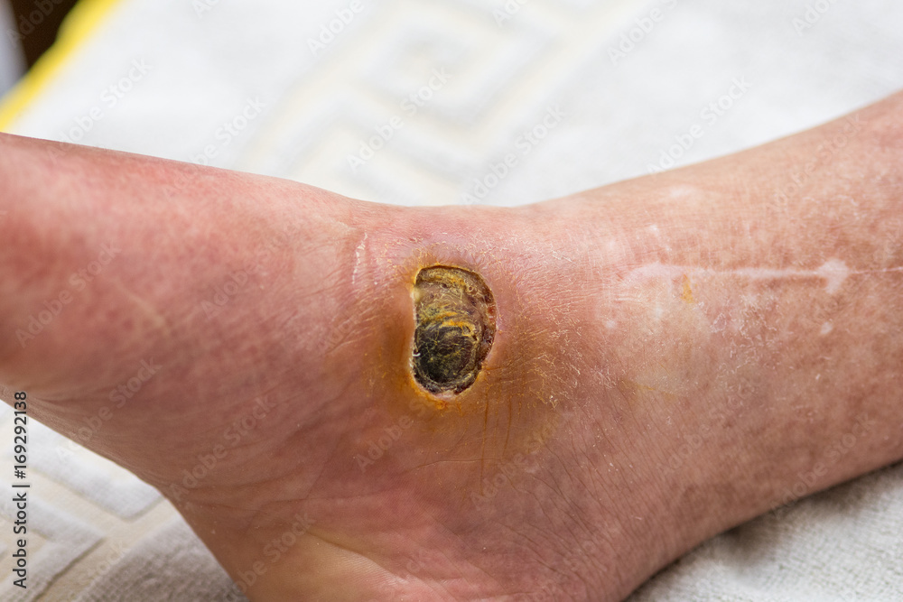 Diabetic Foot