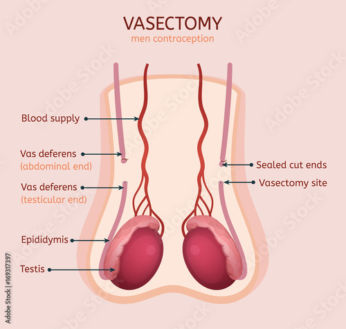Man vasectomy image