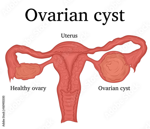Illustration of Ovarian cyst
