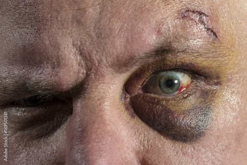 shiner black eye