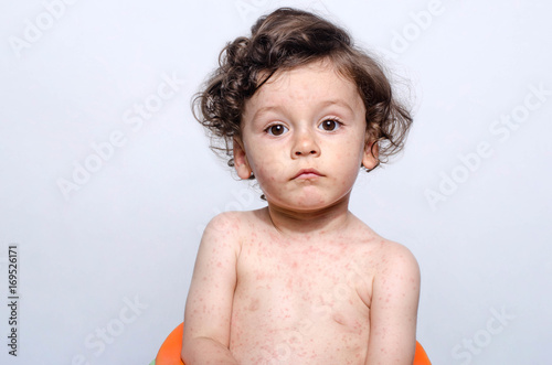 Portrait of a cute sick baby boy. Adorable upset child with spots on his face and body form illness, mosquito bites, roseola, rubella, measles. photo
