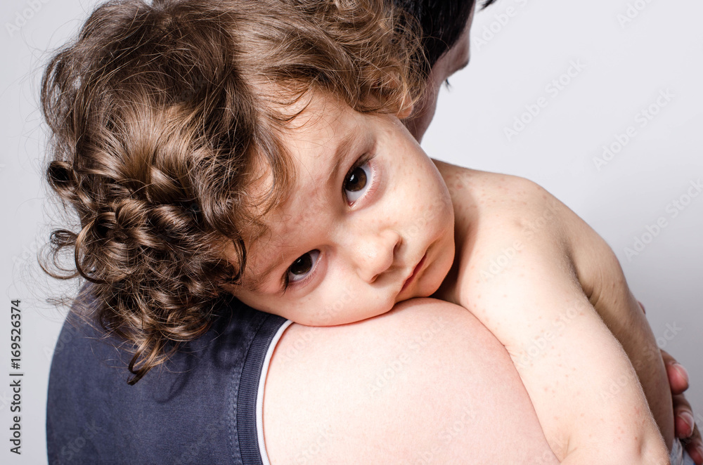 Father holding a cute sick baby boy. Adorable upset child with spots on his face and body form illness, mosquito bites, roseola, rubella, measles resting on his parent shoulder. - obrazy, fototapety, plakaty 
