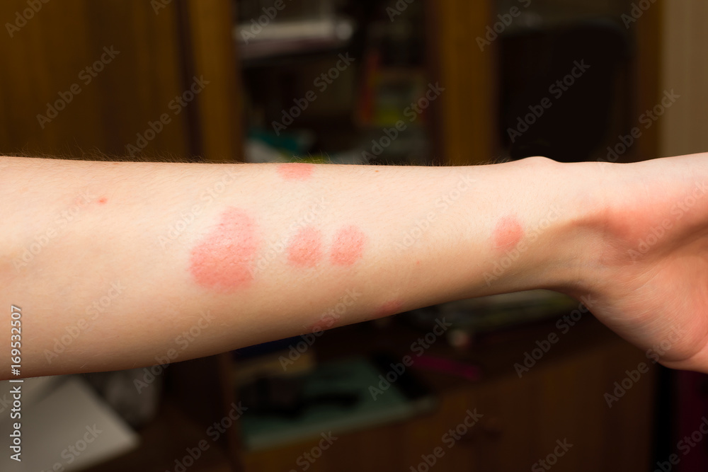 Obraz premium Hand with bites from fleas