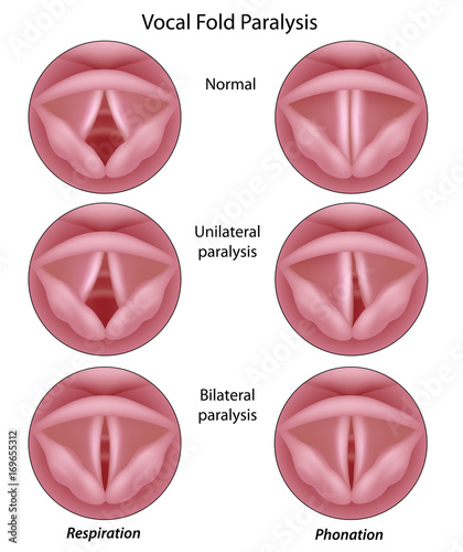 Vocal cord paralysis photo