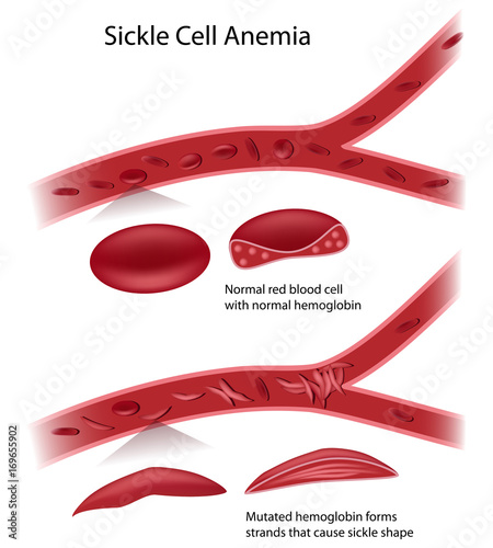 Canvas-taulu Sickle cell disease - anemia.