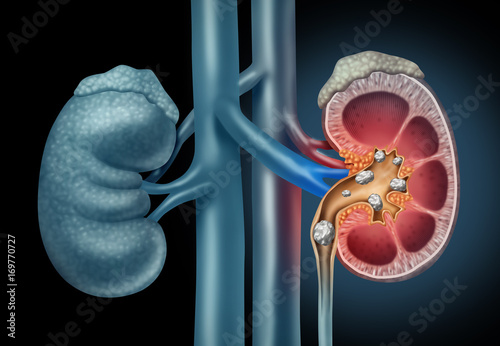 Human kidney Stones Medical Concept photo
