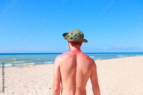 Young man standing on the beach with sunburned shoulders