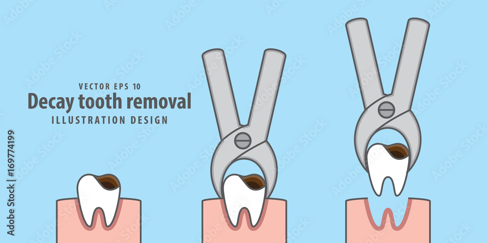 Fototapeta premium Decay tooth removal illustration vector on blue background. Dental concept.