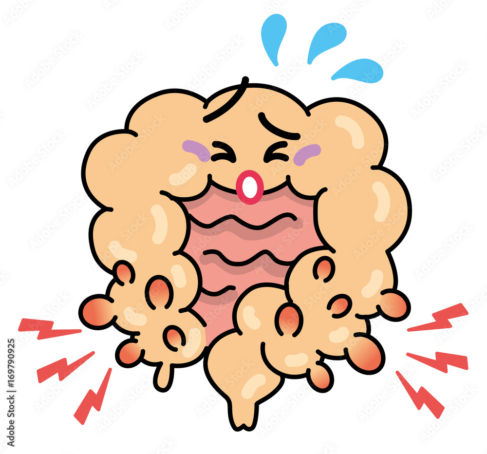 大腸憩室炎 Stock イラスト Adobe Stock