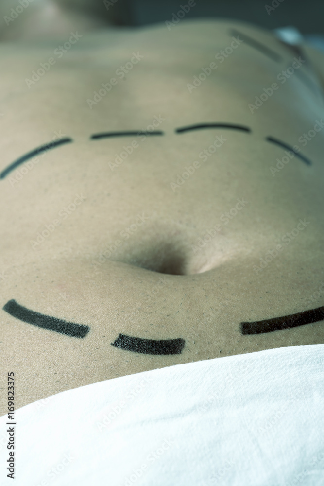 Obraz premium man having a plastic surgery or a liposuction