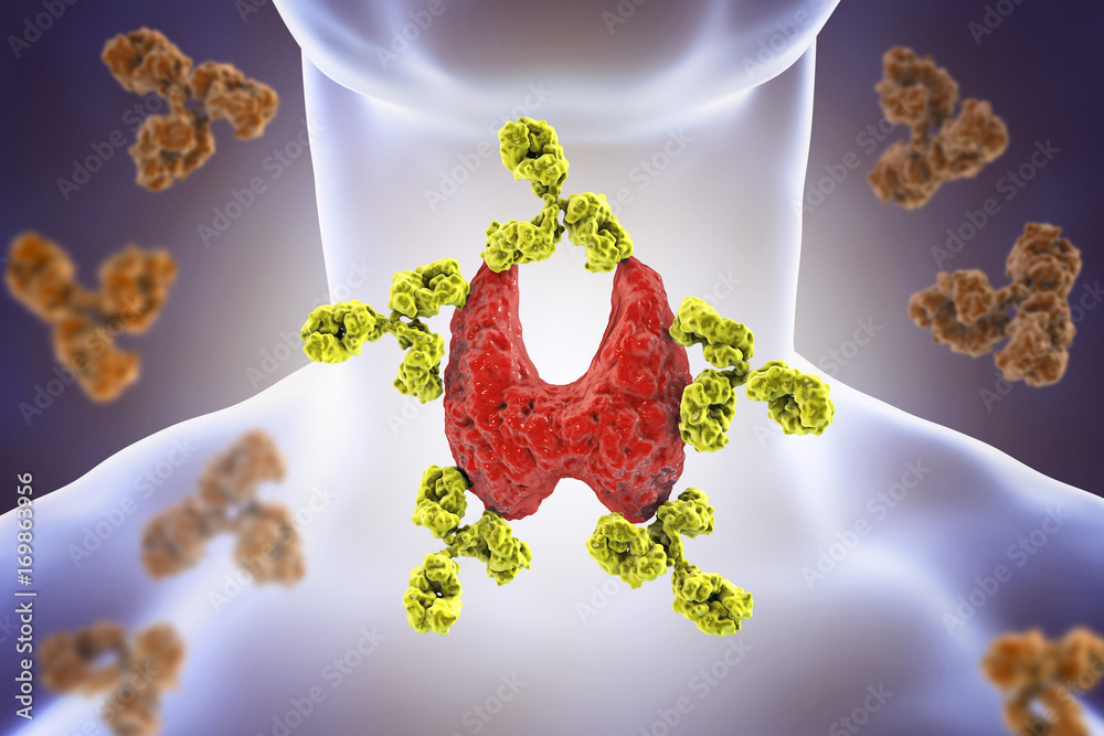 Autoimmune thyroiditis, Hashimoto's disease. 3D illustration showing