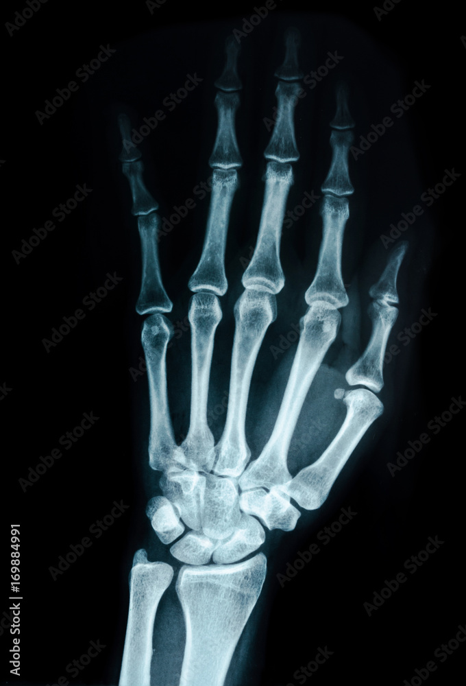 Hand x-ray view. Hand x-ray view.