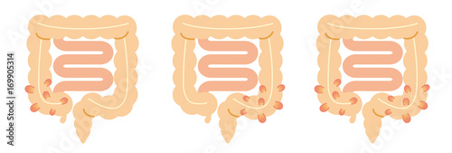 大腸憩室炎