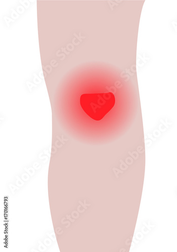 1407125 Swelling of the knee from infected or injury