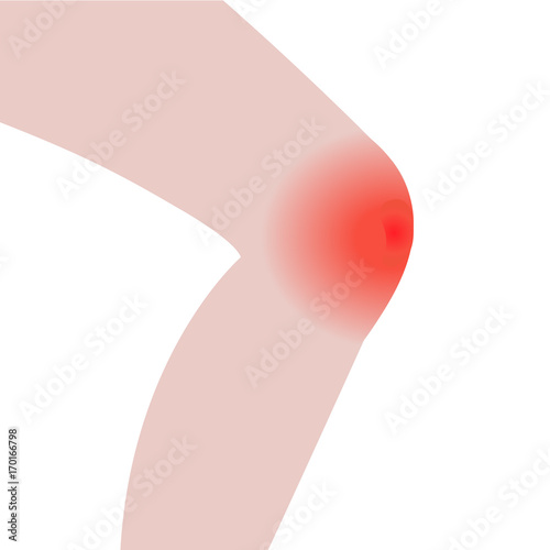 1407124 Swelling of the knee  from infected or injury
