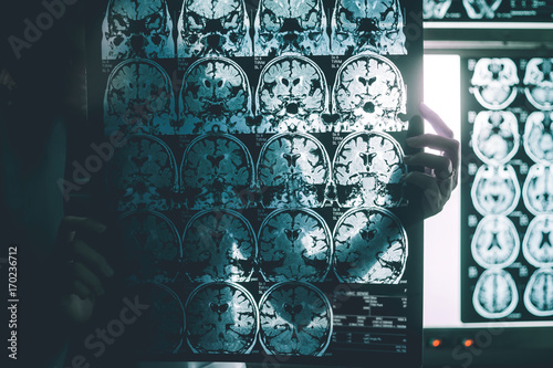 Alzheimer's disease on MRI film 