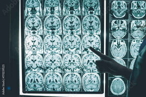 Alzheimer's disease on MRI film 