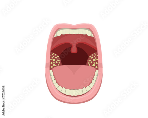 Inflamed Tonsillitis in vector design