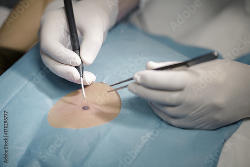 Dermatologist removes mole, close-up photo