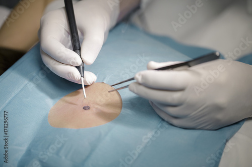 Dermatologist removes mole, close-up