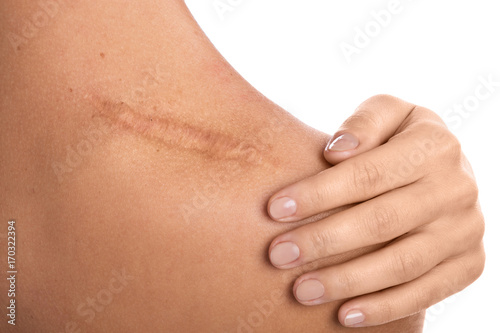 Woman with a scar on her shoulder Fototapet