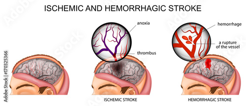 ischemic and hemorrhagic stroke photo