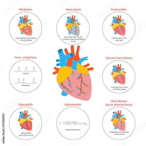 Cartoon Heart Disease Infographic Card or Poster. Vector