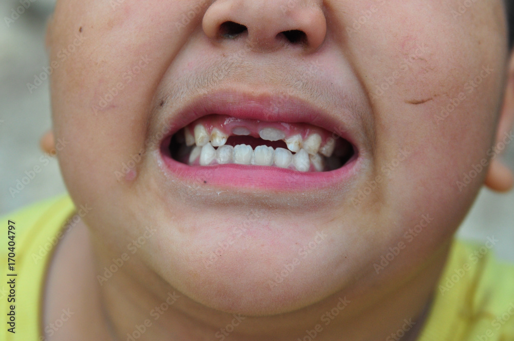 Fototapeta premium view of an Asian boy with broken teeth