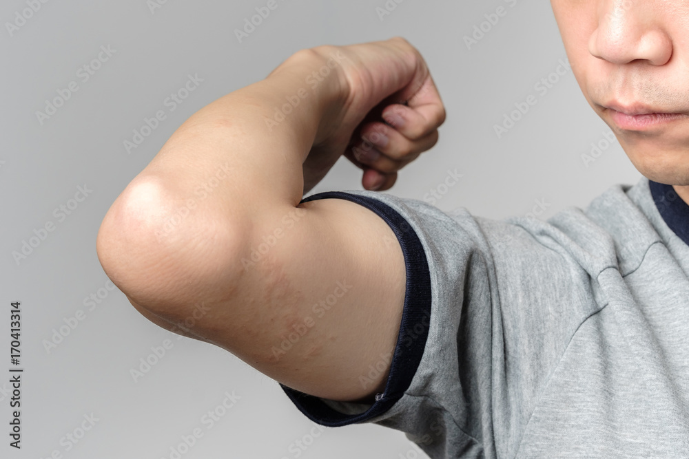 Fototapeta premium Allergy rash