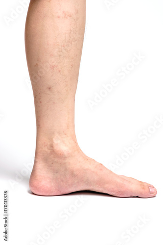 Allergic rash dermatitis eczema skin of patient legs