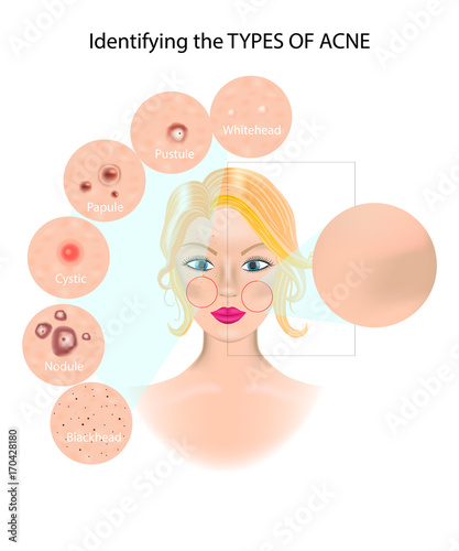 Types of Acne. Infographics
