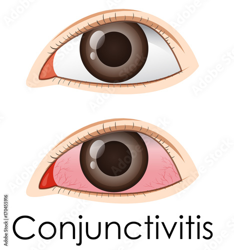 Conjunctivitis in human eyes