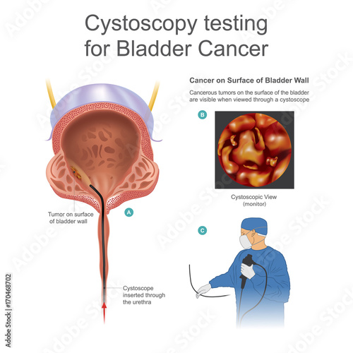 Bladder cancer is any of several types of cancer arising from the tissues of the urinary bladder. Info graphic vector.