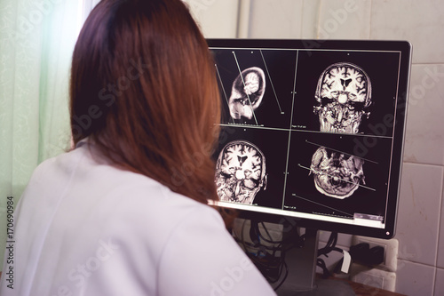 MRI brain of Dementia patient Hippocampal atrophy grade 4 by MTA scale Temporal atrophy