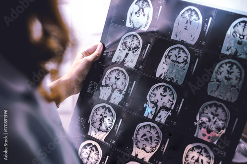 Fotografie brain atrophy on MRI of Dementia patient