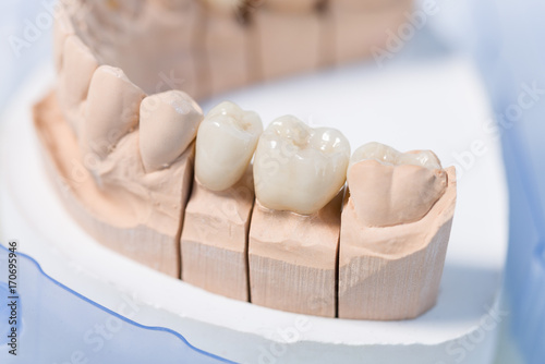 Detailaufnahme eines Prothesensattels mit Zahnersatz im Zahnlabor