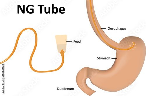 NG Tube Labeled Diagram