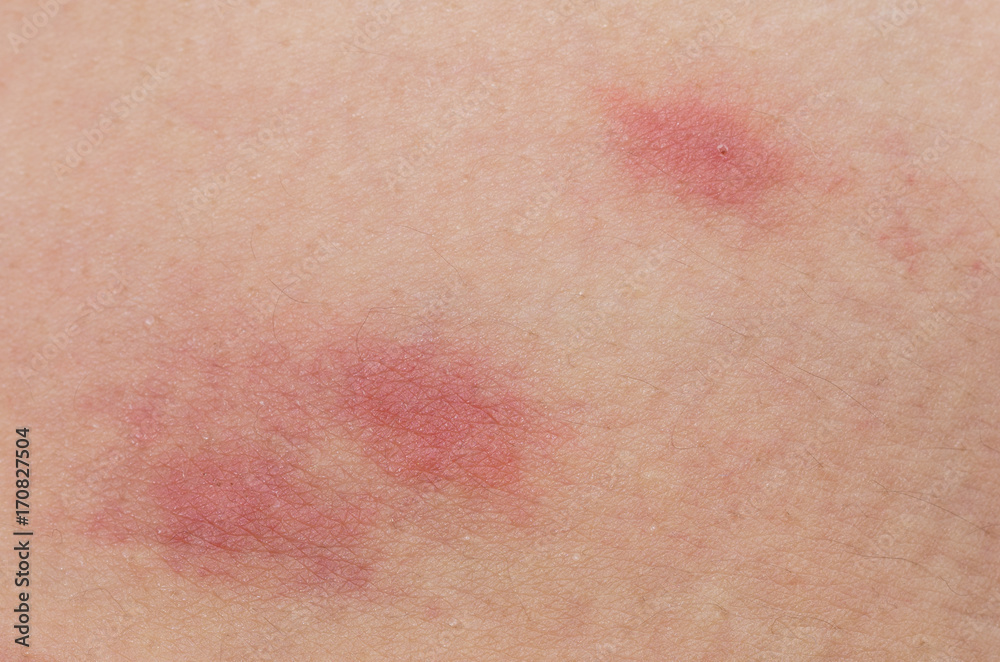 closeup of flea bites closeup of flea bites