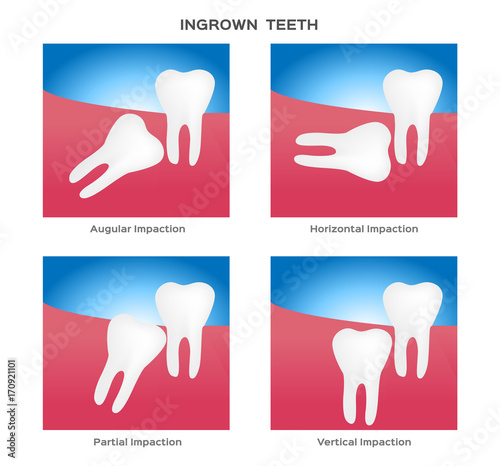 impacted and wisdom tooth vector