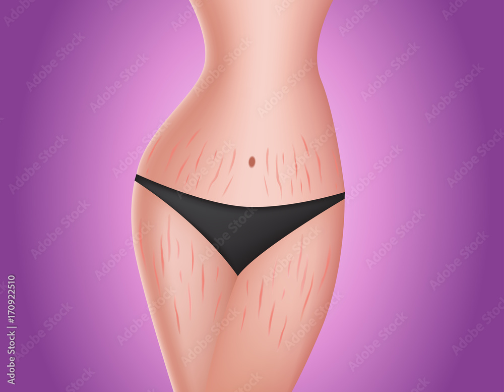 stretch-marks-on-body-skin-care-concept-vector-stock-vector-adobe-stock