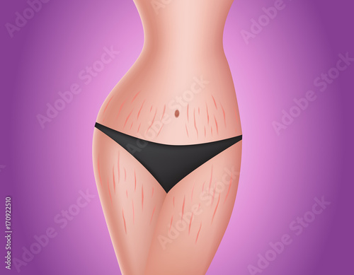 stretch marks on body . Skin care concept vector