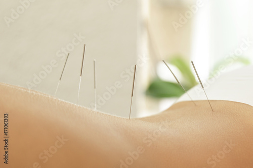 Female back with steel needles during procedure of acupuncture therapy photo