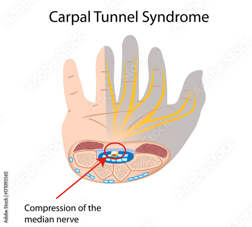 Fotografia Carpal tunnel syndrome