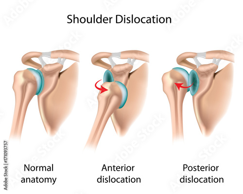 Shoulder dislocation  photo