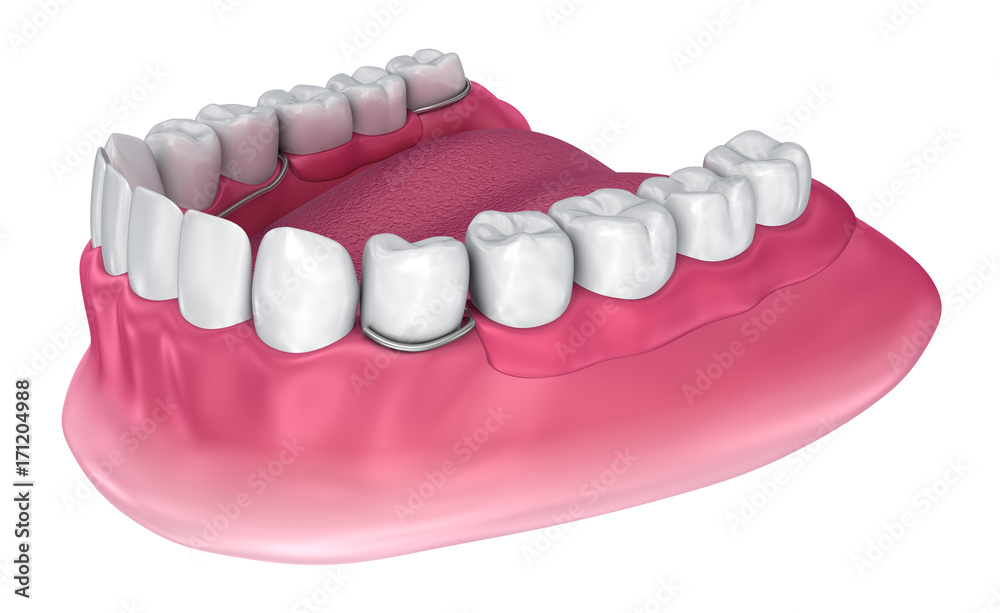 Fototapeta premium Removable partial denture. Medically accurate 3D illustration