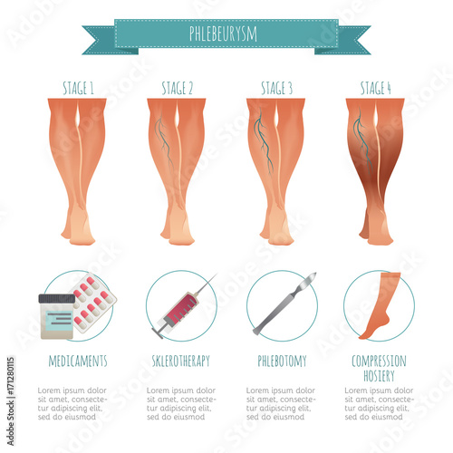 Phlebology infographic, treating varicose veins. Vector illustration of stage of vein diseases. Medical compression hosiery