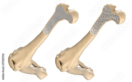 Human Thigh Bone - Normal and with Osteoporosis. 3D illustration