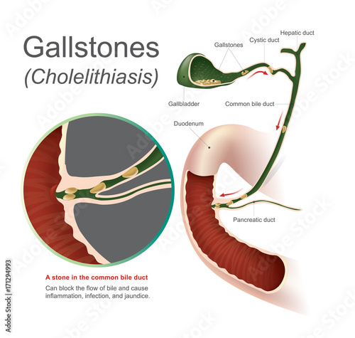 Gallstones cholelithiasis. A stone in the common bile duct, gallstones can block the flow of bile and cause inflammation infection and jaundice, Info graphic Vector. photo