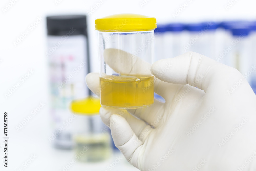 Medical urine test, close-up,Doctor holding a container in hand, isolated on white, Urine sample test. Medical urine test, close-up,Doctor holding a container in hand, isolated on white, Urine sample test.